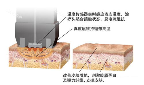 钻石超塑的作用