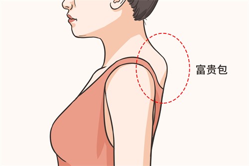 富贵包解决方案：吸脂还是手术切除更佳？价格咨询