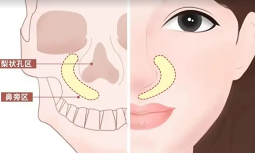 告别鼻基底凹陷！鼻基底凹陷怎么改善？鼻基底凹陷填充材料|优缺点汇总！
