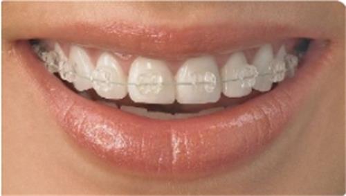 码住！戴牙套可以矫正嘴凸吗？仅适合牙齿排列不齐导致的嘴凸，还有矫正后的注意事项