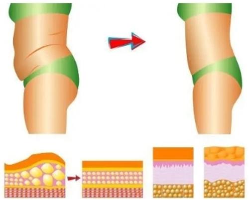 请问：抽脂肪对身体有没有伤害？因人而异，术前/术中等各类风险都摆在这