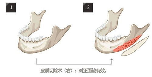 求助帖！方脸削骨大概多少钱？根据医生技术/手术难度/医院等级有所不同，一般在1.5w+