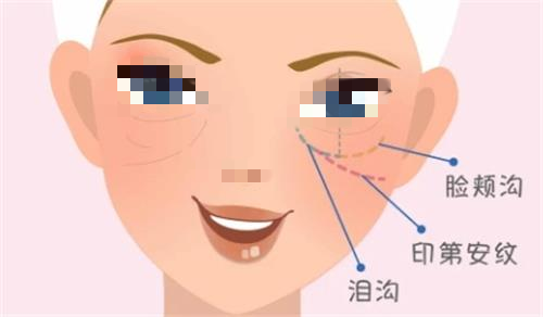 速来：泪沟填充哪种方法更好？多少钱？一文带你了解泪沟填充的五种方式及详细价格