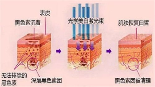 科普：光子嫩肤要做几次有效？光子嫩肤的作用是什么？一文给你解答