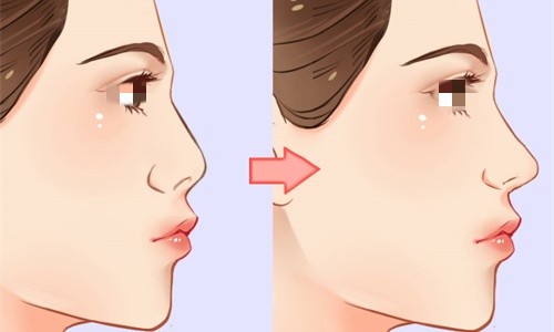 解惑鼻子整形：鼻子整形手术一般多少钱？可以维持一辈子吗？一篇全知道