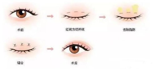 颜值升级计划：什么年龄割双眼皮较好？没有固定答案，建议眼部结构相对稳定在做双眼皮