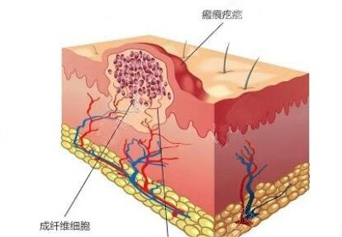 疤痕增生的来龙去脉：疤痕增生是怎么回事？怎么才能去除？一文全知道