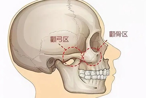 颧骨内推手术改善期全解析：手术介绍/初期改善/消肿期/愈合期/自然期详细介绍