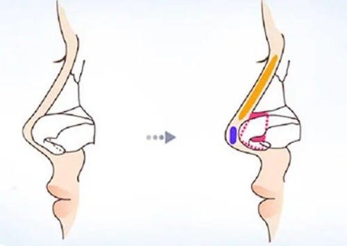 鼻小柱延长和抬高介绍：从手术方式、适应症、目标等多方面解析二者区别