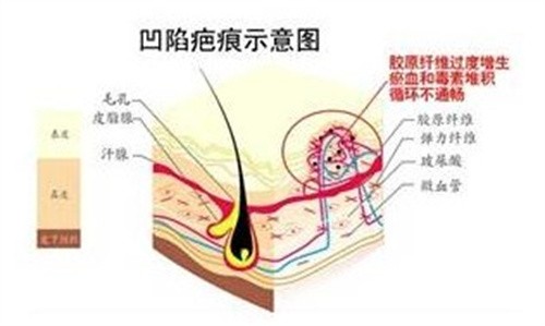 十几年的凹陷疤痕能修复吗？可修复，激光|微针|填充等都是凹陷疤痕克星