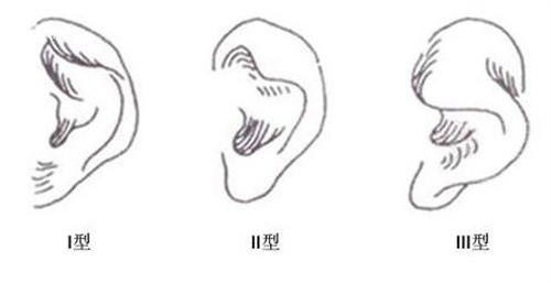 小耳畸形矫正手术的费用和程序：自体软骨移植2w+、义骨植入3w+