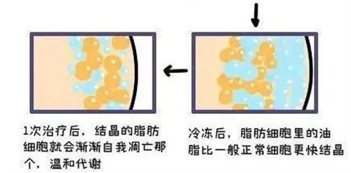 酷塑冷冻溶脂16个点会瘦多少？一般来说可以减少约22%的脂肪厚度