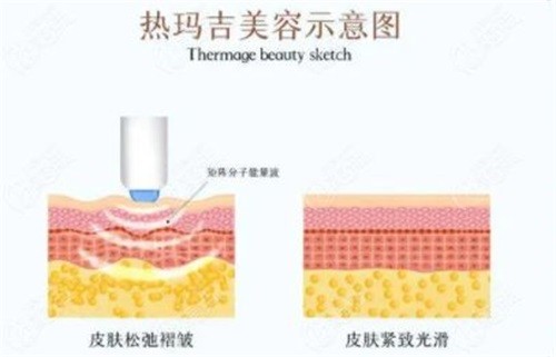 北京热玛吉消费高吗？不高，眼周15800+面部14800+面颈18800+四代热玛吉8700+