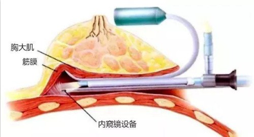 深圳哪个医生做假体隆胸有名？胡琼华|贾振华|李罡凭借出色的技术有名