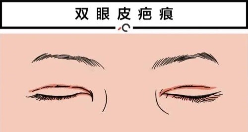 北京张冰洁眼部修复贵吗？双眼皮|内外眼角36000+价格与修复成效的深度剖析