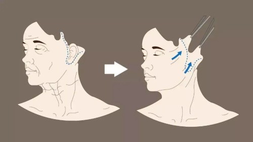 小切口拉皮手术详解：维持时间+主要功效