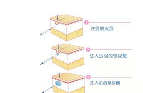 玻尿酸填充面部有哪些危害？玻尿酸填充凹陷能维持多长时间？