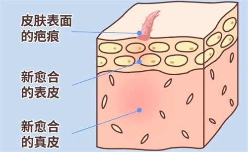 山西治疗淡化疤痕得花多少钱？普通疤痕2000+增生|挛缩疤痕8000+激光祛疤3000+术后护理500+