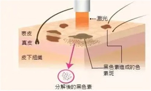 徐州祛斑大概多少钱？全新价格显示：激光祛斑1890+皮秒祛斑900+瓷肌祛斑1100+