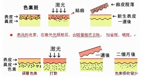 做蜂巢皮秒到底结不结痂？可能会轻微结痂，修复期间需特别护理