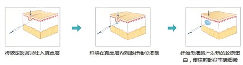 自体脂肪和玻尿酸填充哪个更好一些？大面积填充用自体脂肪更放心，小部位用玻尿酸即刻成效好