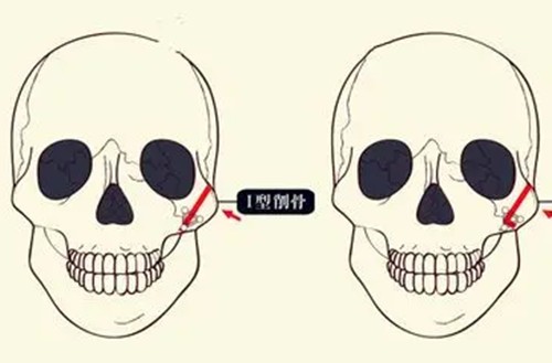 国内做磨骨好的医生有哪些？上海曹栋弼|河南赵绛波|广东柳超|北京张笑天磨骨人气高