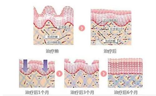 热拉提会溶解掉玻尿酸吗？不会溶解，热拉提专注胶原再生|玻尿酸共存无惧溶解！