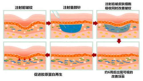 艾塑菲童颜针多少钱？艾塑菲童颜针一般多久打一次？一支4300+半年|一年左右打一次