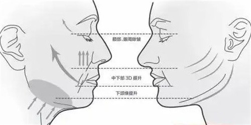 网兜面部提升术适合多大年龄的人？适合35岁以上有法令纹|苹果肌下垂的朋友