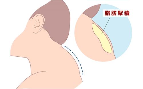 富贵包脂肪示例图.jpg