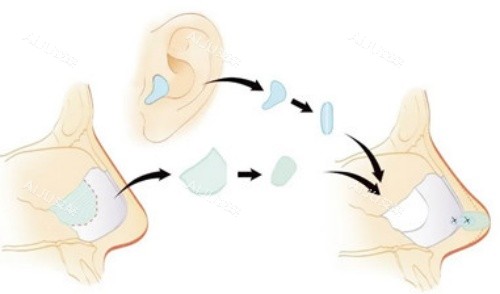 塌鼻子鼻梁低怎么办？自体软骨隆鼻手术改善鼻子塌效果显著