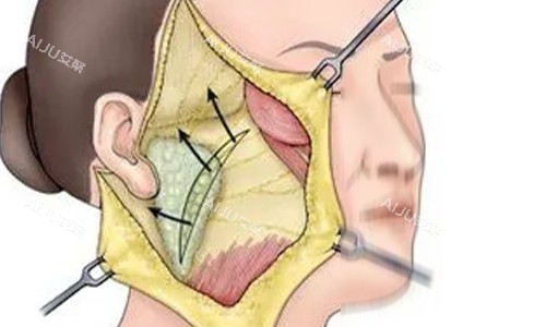 拉皮手术剖开动画示意图