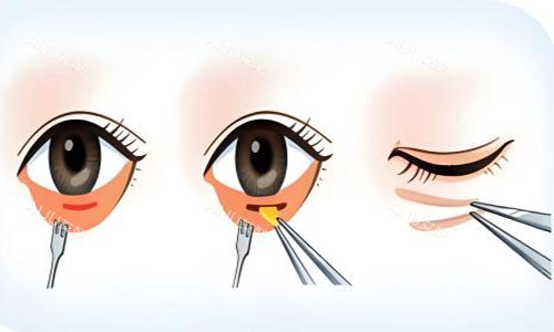 祛眼袋手术动画图