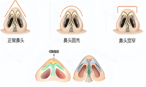 鼻翼缩小种类