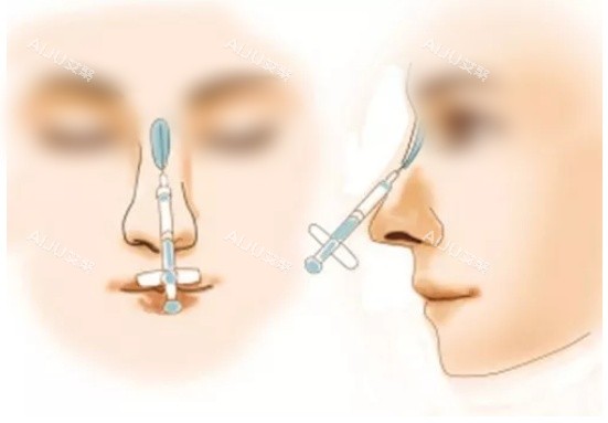 注射垫鼻示意图