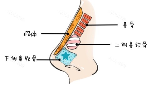 假体垫鼻示意图