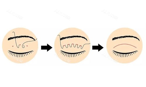 埋线双眼皮手术示意图