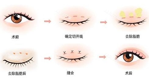 双眼皮术前术后示意图