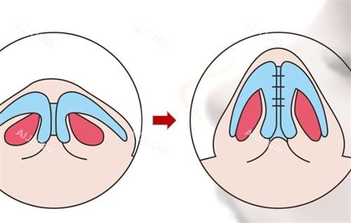 鼻小柱延长前后清晰对比图