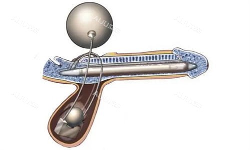 阴茎植入示意图