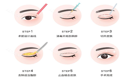 双眼皮手术过程示意图