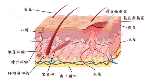 增生疤痕是怎么形成的