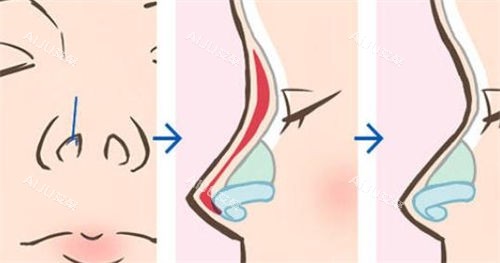 鼻部综合隆鼻术前术后展示图