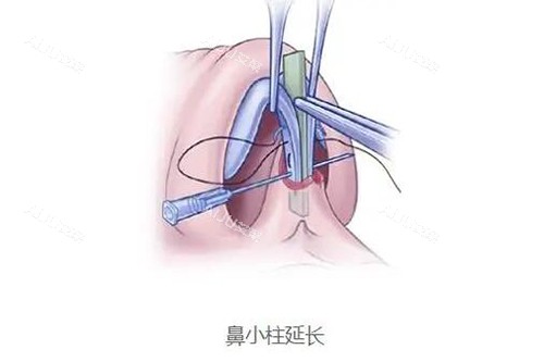 鼻小柱延长用什么材料好一点? 软骨/硅胶哪个才是