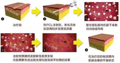 爱塑美童颜针注射前后变化图解