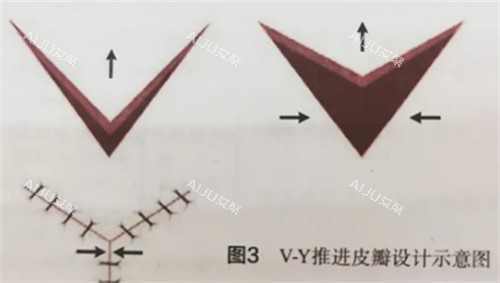 v-y成型法