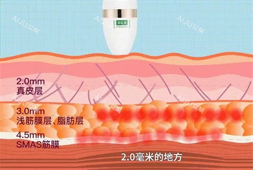 超声炮层次