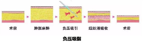 抽脂手术方式动画图