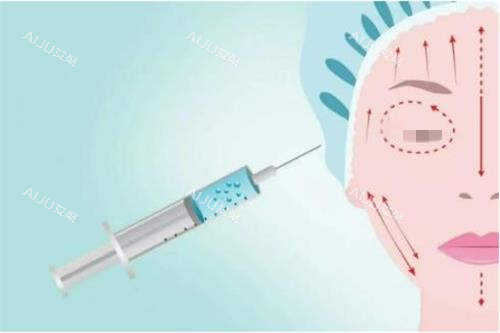 注射玻尿酸示意图