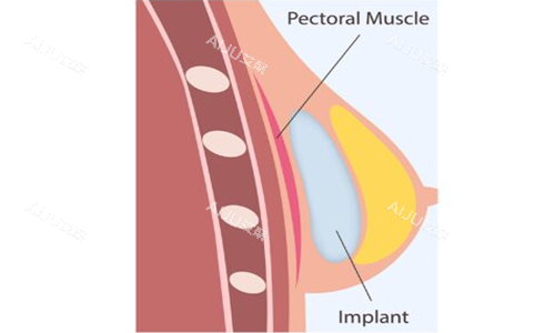 隆胸假体植入位置示意图